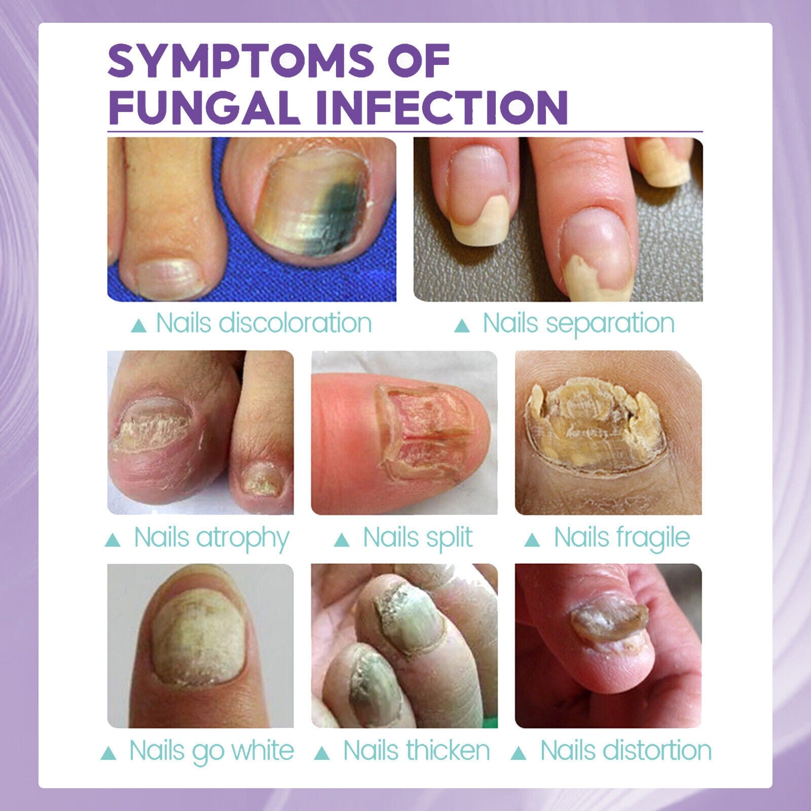 Medinail nail fungus  Care Spray